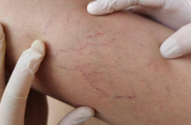 лечение на разширени вени - 15398 клиенти