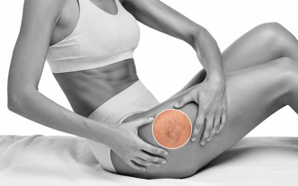 лечение на разширени вени - 43256 промоции