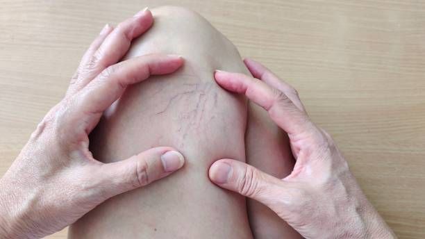 лечение на разширени вени - 42607 типа