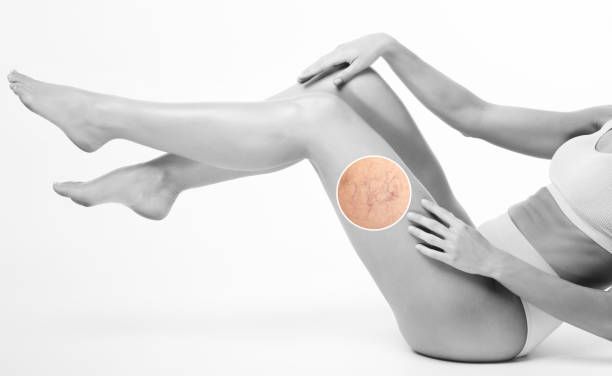 лечение на разширени вени - 24624 селекции