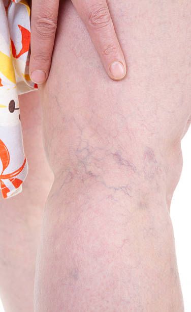 склеротерапия - 81715 възможности